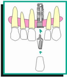 Implantes dentales