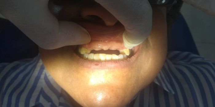 Elite Dental Care Antes y Después