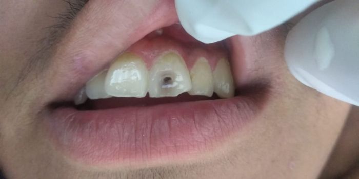 Elite Dental Care Antes y Después