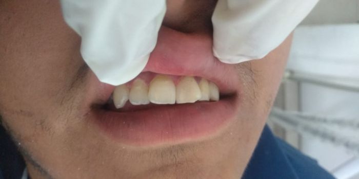 Elite Dental Care Antes y Después